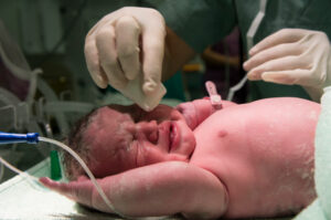 רשלנות רפואית בלידה